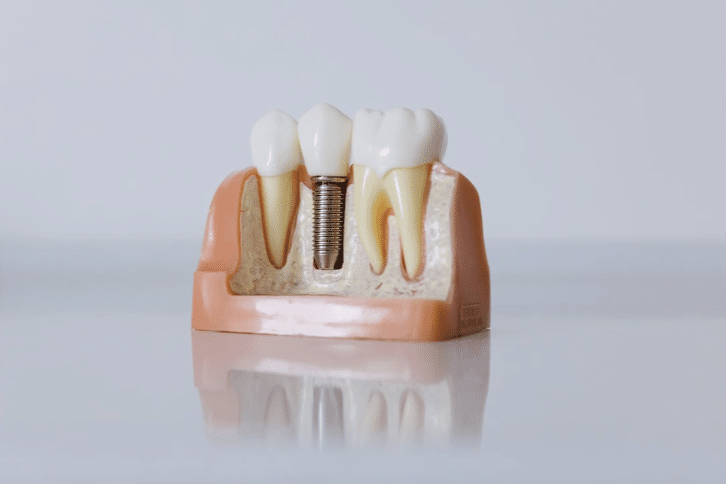 Implante dentário?